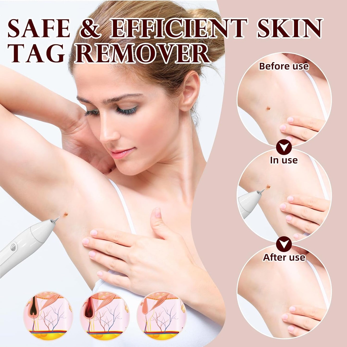 LM 1000 SkinTag Remover Home Use, Removal of Common Warts, SkinTags | Easy to Use